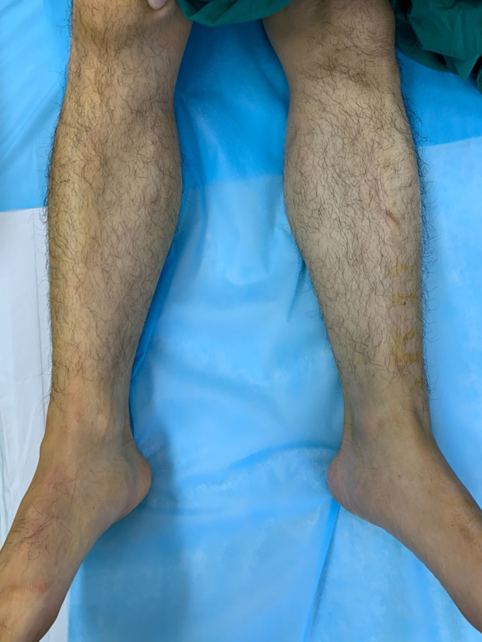 Không lệch chân là kết quả sau thay khớp háng tại Trung tâm Chấn thương Chỉnh hình . Ảnh: BVĐK Tâm Anh