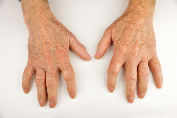Hiện tượng bàn tay xúc xích ở người bệnh PsA là tình trạng viêm, sưng đau toàn bộ các ngón tay. Ảnh Dreamstime