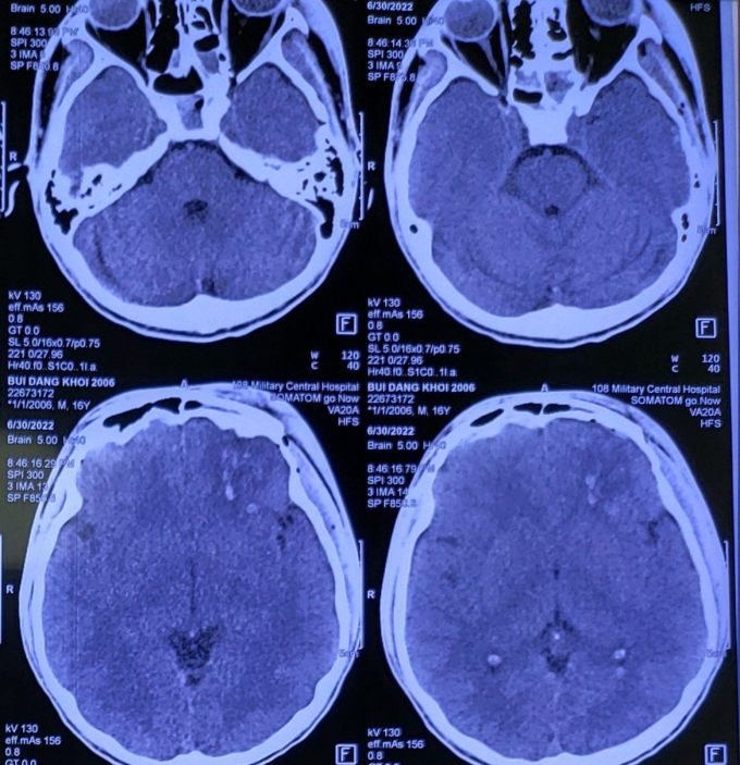 Hình ảnh Xquang sọ não bệnh nhân. Ảnh: Bệnh viện cung cấp