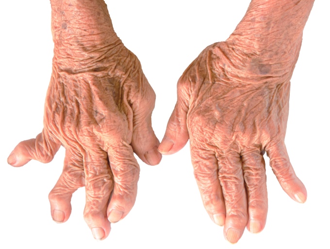 Biến chứng bàn tay gió thổi ảnh hưởng chức năng cầm nắm của người bệnh. Ảnh: Shutterstock