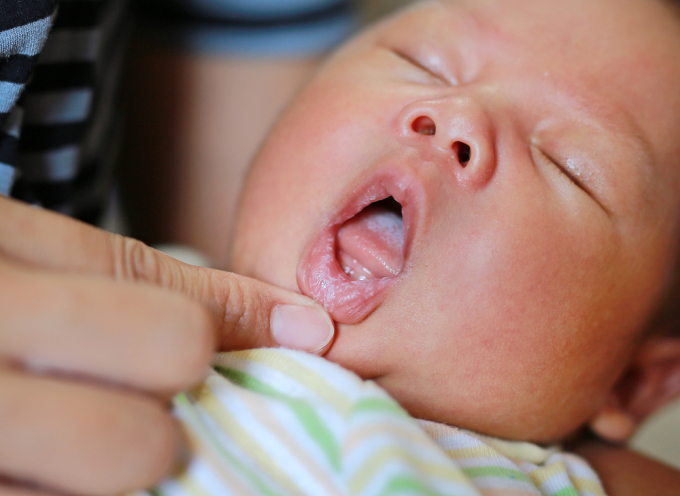 Trẻ sơ sinh bị nấm ký sinh trên lưỡi, môi. Ảnh: Shutterstock