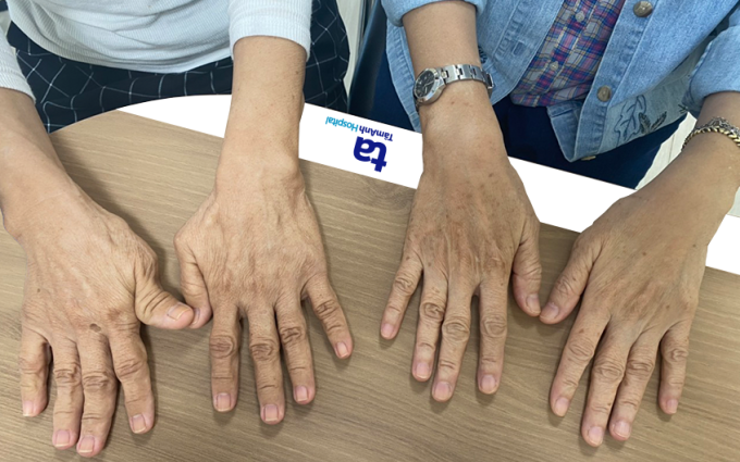 Hai bàn tay bà Hà (bên trái) to hơn bàn tay người bình thường (bên phải) do bệnh to đầu chi. Ảnh: Bệnh viện cung cấp.