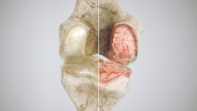 Bề mặt sụn khớp của khớp khỏe mạnh (trái) và thoái hóa khớp (phải). Ảnh: Shutterstock