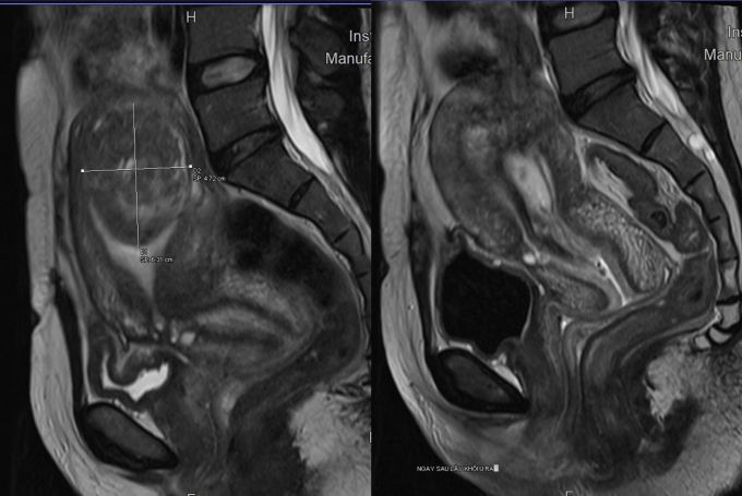 Hình ảnh khối u xơ trước nút mạch (bên trái) và sau khi lấy ra (bên phải). Ảnh: BVĐK Tâm Anh