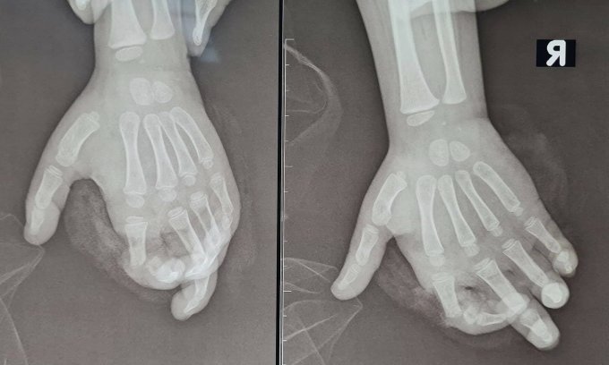 Phim chụp X-quang tổn thương của bệnh nhân. Ảnh: Bệnh viện cung cấp