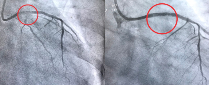 Động mạch vành bị tắc trước (trái) và sau khi được hút huyết khối và đặt stent. Ảnh: Bệnh viện cung cấp