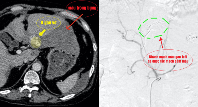 Hình ảnh ổ bụng bệnh nhân (trái) và phần gan trước và sau can thiệp nút mạch máu. Ảnh: Bệnh viện cung cấp