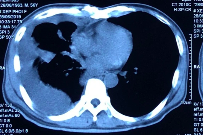 Hình ảnh chụp X-quang lồng ngực bệnh nhân. Ảnh: Bác sĩ cung cấp
