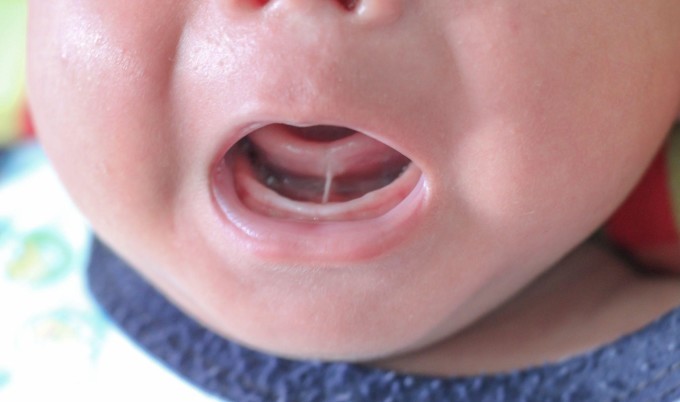 Thăm khám giúp phát hiện sớm tật dính thắng lưỡi bẩm sinh ở trẻ. Ảnh: Shutterstock