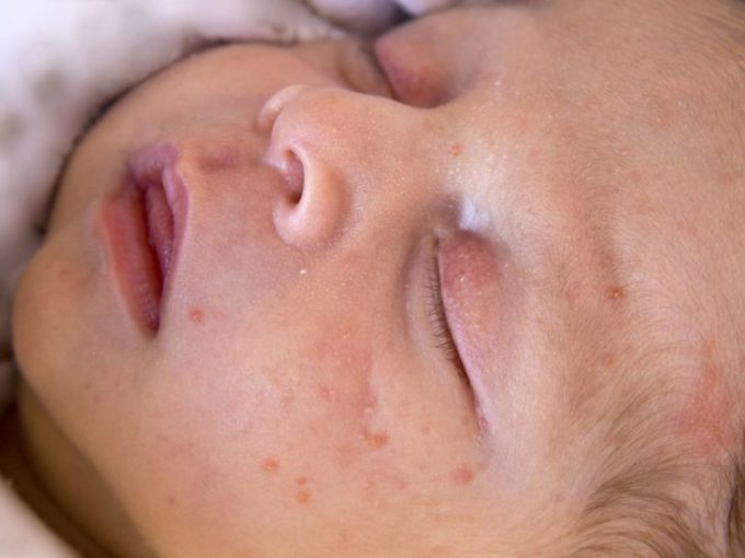 Trẻ sơ sinh dễ nổi mụn trứng cá ở da mặt. Ảnh: Medicalnewstoday