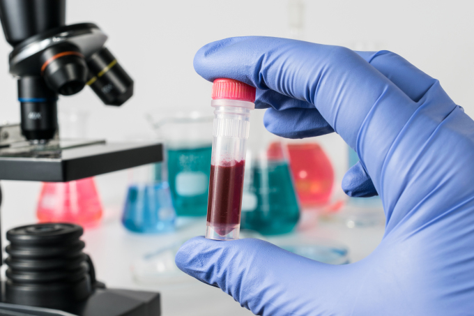 Xét nghiệm máu thường được dùng để kiểm tra tình trạng gan. Ảnh: Shutterstock